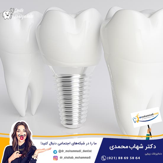 مشکلی به نام لق شدن ایمپلنت و راههای جلوگیری از آن - کلینیک دندانپزشکی دکتر شهاب محمدی